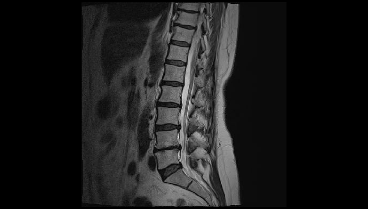 diagnoza bólu pleców w odcinku lędźwiowym