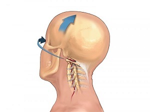 jak objawia się osteochondroza kręgosłupa szyjnego