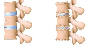 jak rozpoznać obecność osteochondrozy kręgosłupa lędźwiowego