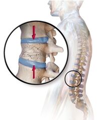 Osteoporoza wywołuje ból pleców w okolicy lędźwiowej