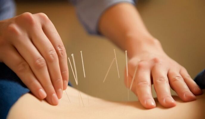 akupunktura w leczeniu bólu krzyża